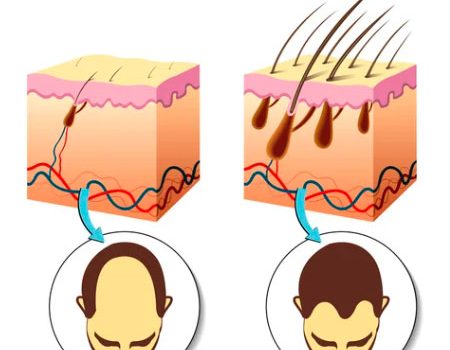 Finasteride sans ordonnance